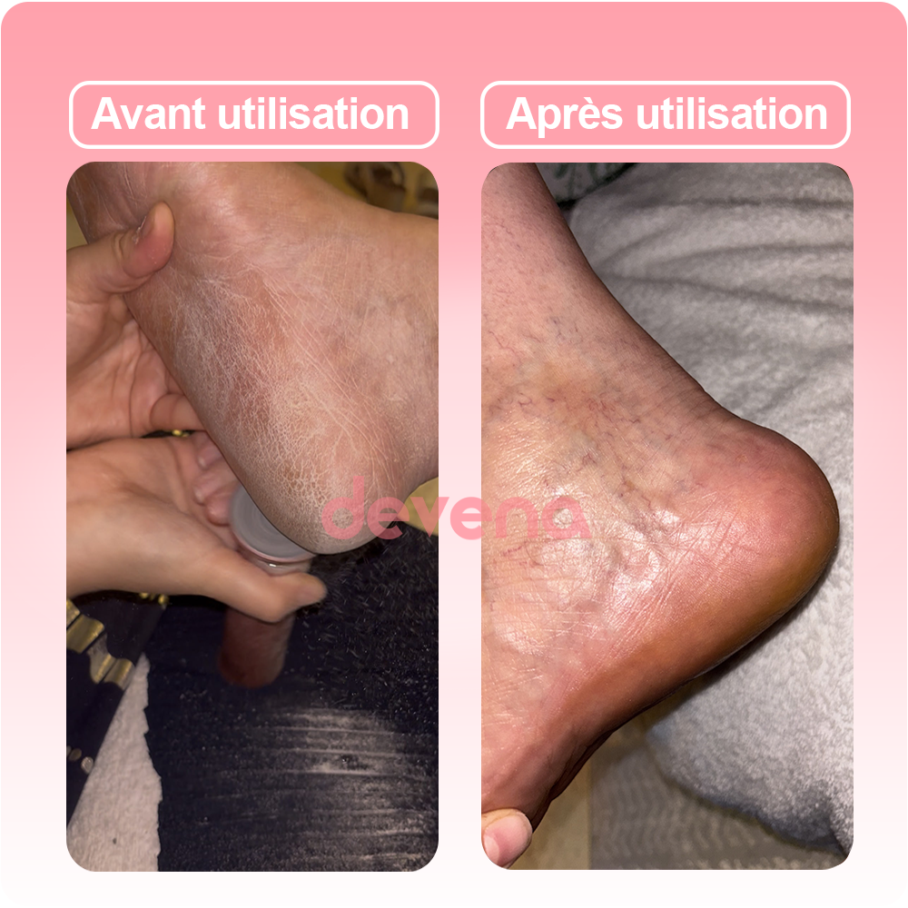 Ponceuse Glow - Retrouvez l'éclat et la douceur de votre peau comme au premier jour