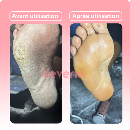 Ponceuse Glow - Retrouvez l'éclat et la douceur de votre peau comme au premier jour